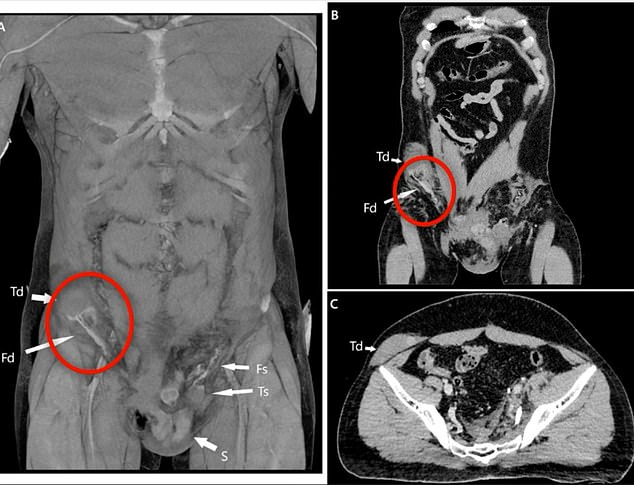 His right teste (circled in red) had been forced from its usual spot in the scrotum ¿ the thin sac of skin keeping the testicles in place ¿ through a small passageway in the groin and up into the abdomen
