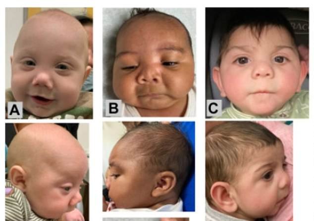 The babies found to be affected by maternal fentanyl use had smaller heads and underdeveloped jawbones overall