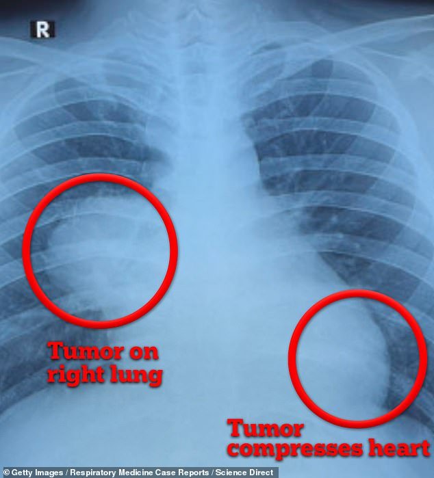 The patient's scan shows a mass on his right side near his lung, which pressed against his heart [shown on the right side of the image, but is the left side of his chest]